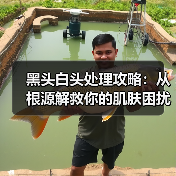 黑头白头处理攻略:从根源解救你的肌肤困扰(图2) 黑头白头处理攻略:从根源解救你的肌肤困扰(图2)